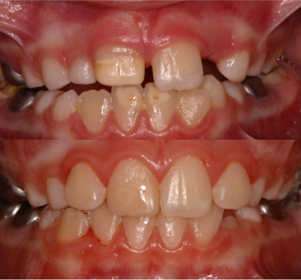 Cosmetic management of affected permanent incisors Cosmetic management of affected permanent incisors