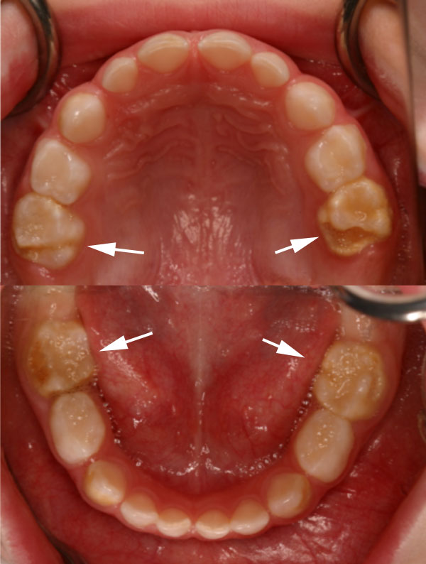 Hypomineralisation second primary molars and cuspids