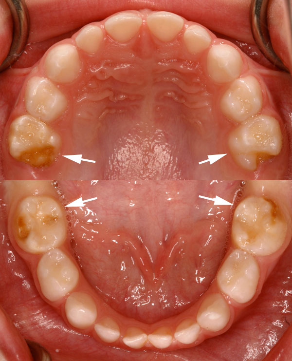 Hypomineralisation second primary molars