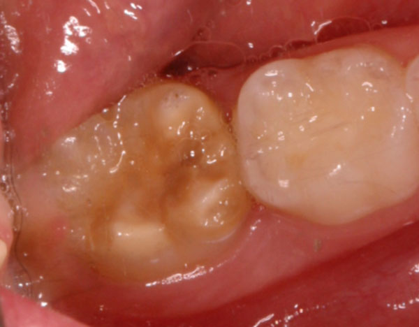 Hypomineralised First Permanent Molar Hypomineralised molar