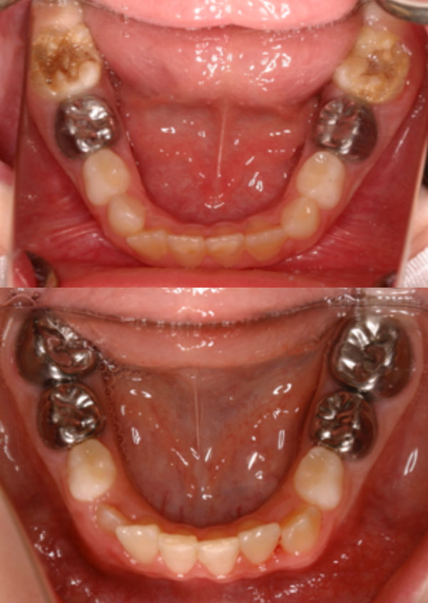 Preformed stainless steel crowns stabilise affected teeth
